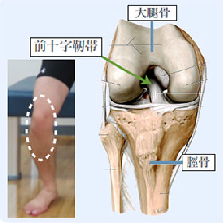 前十字靭帯