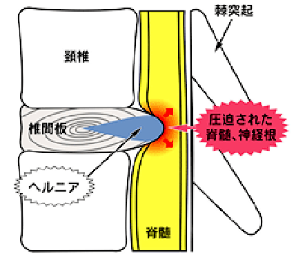 頚椎椎間板ヘルニア